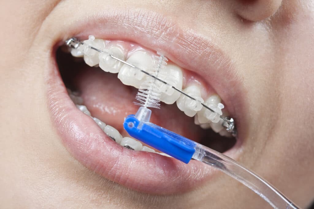 Reinigung Brackets Drähte