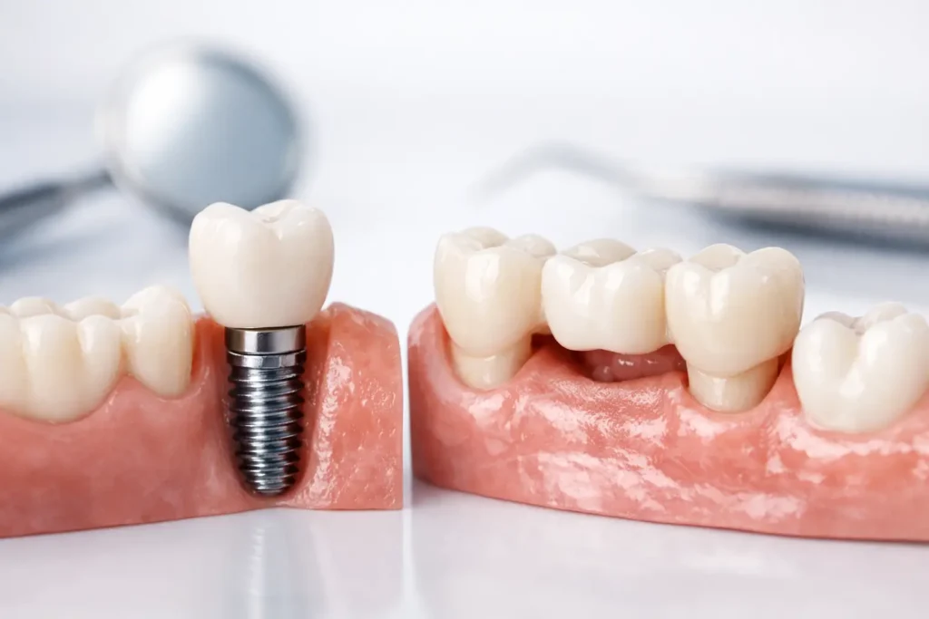 Implantat oder Brücke - was ist besser?