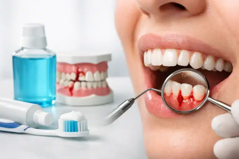 Die besten Treatments für bleeding gums